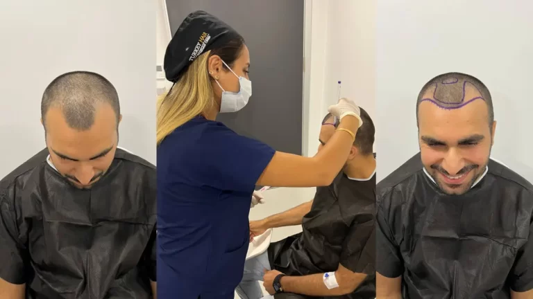Türkiye Saç Ekimi Operasyonu (Hair Transplant Turkey) Hakkında Bilgiler